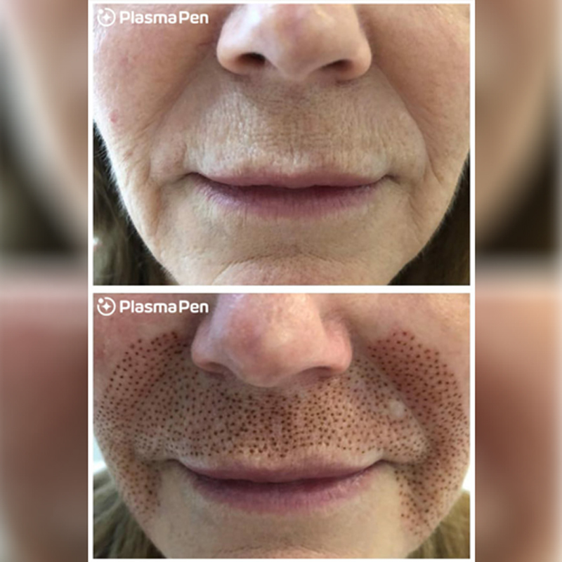 Fibroblast Before and After Photo